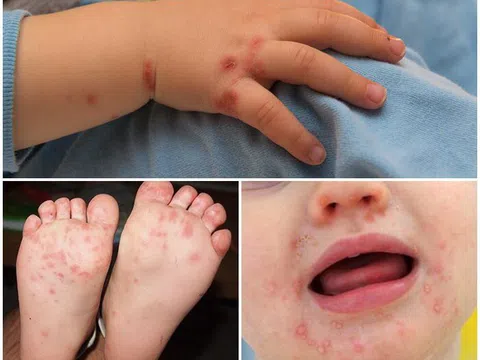 28 quận, huyện của Hà Nội đã xuất hiện dịch tay chân miệng