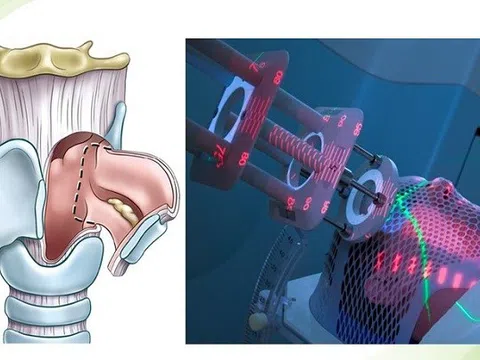 Ứng dụng phẫu thuật laser vi phẫu qua đường miệng trong điều trị ung thư thanh quản