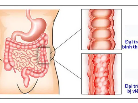 'Đại Tràng Hoàn' – Xua tan nỗi lo bệnh đại tràng