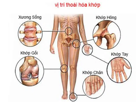 Để viêm khớp dạng thấp không còn là nỗi lo