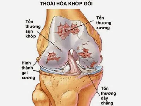 Thoái hóa khớp gối: Nguyên nhân và biện pháp khắc phục hiệu quả, an toàn