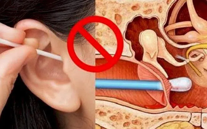 Sai lầm tai hại khi dùng bông ngoáy tai mà hàng triệu người đang mắc phải