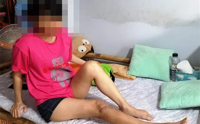 Đà Nẵng: Khởi tố người đánh gãy chân nữ kế toán